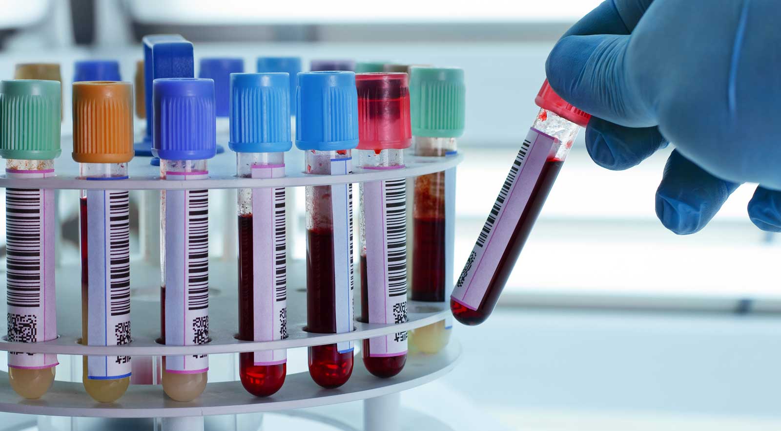 Arthritis Blood Test tathawade